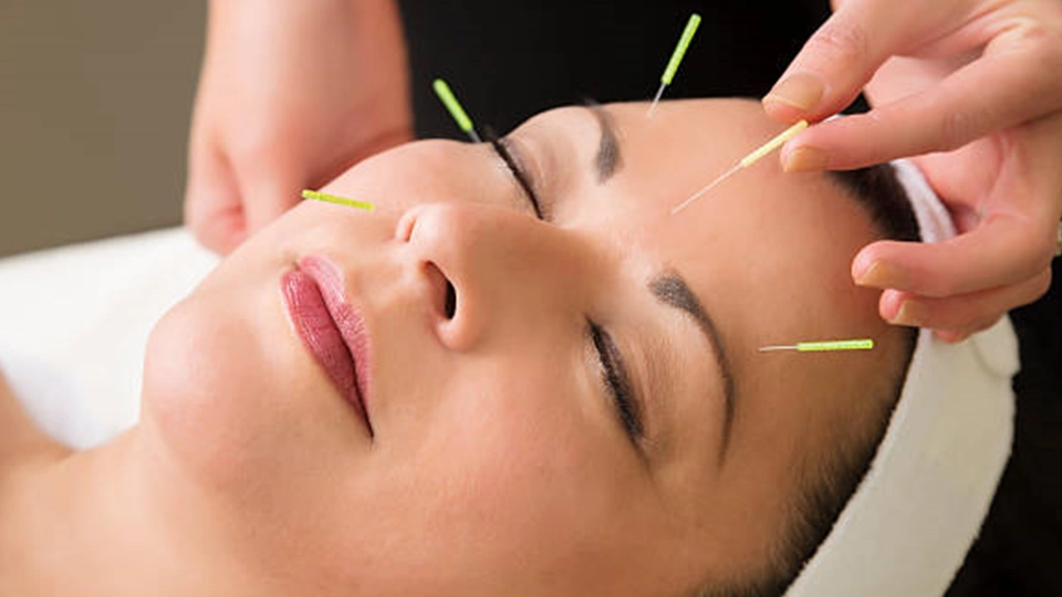 acupunctura cosmetica